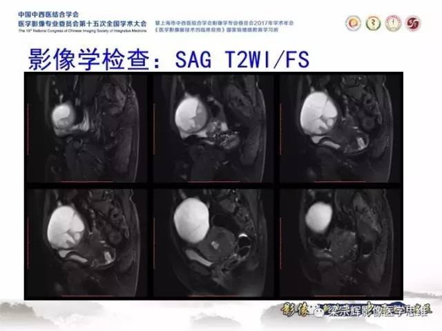 【病例】子宫内膜间质肉瘤1例MR影像表现