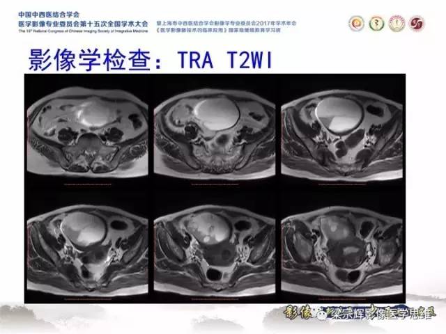 【病例】子宫内膜间质肉瘤1例MR影像表现