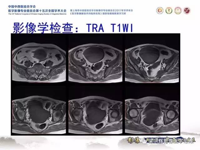 【病例】子宫内膜间质肉瘤1例MR影像表现