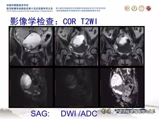 【病例】子宫内膜间质肉瘤1例MR影像表现