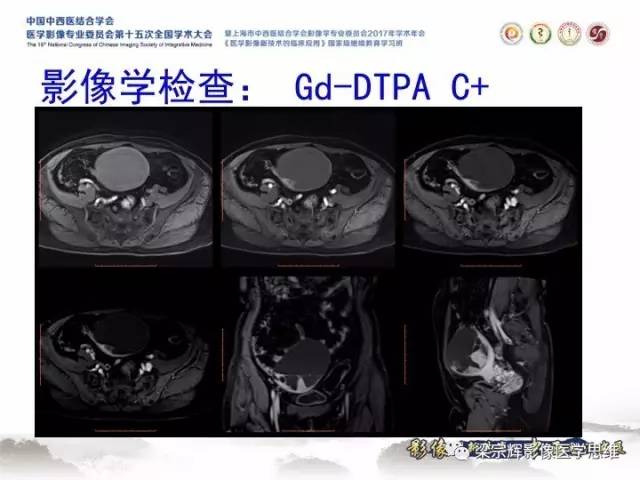 【病例】子宫内膜间质肉瘤1例MR影像表现