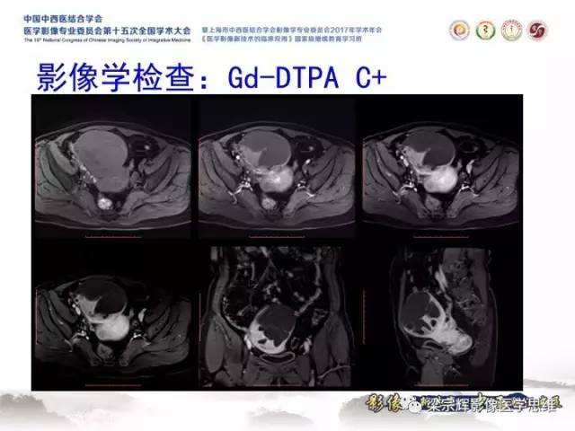 【病例】子宫内膜间质肉瘤1例MR影像表现