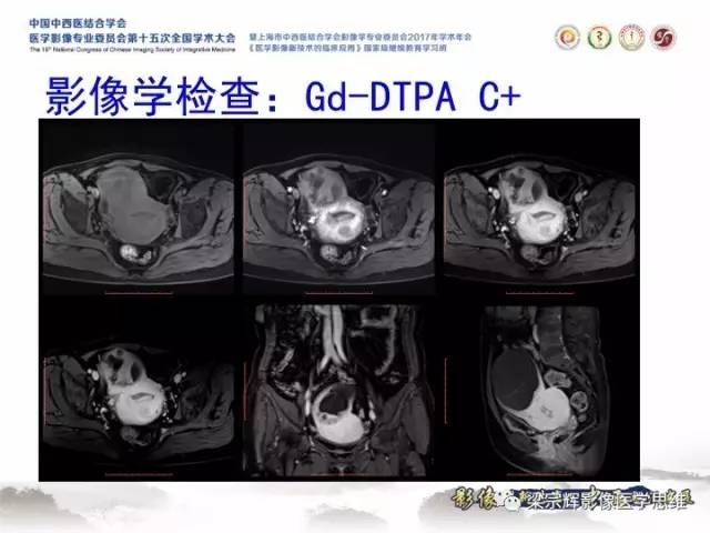 【病例】子宫内膜间质肉瘤1例MR影像表现