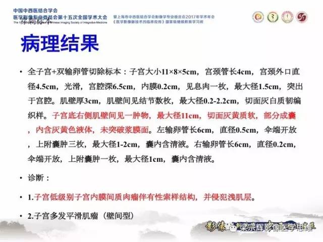 【病例】子宫内膜间质肉瘤1例MR影像表现