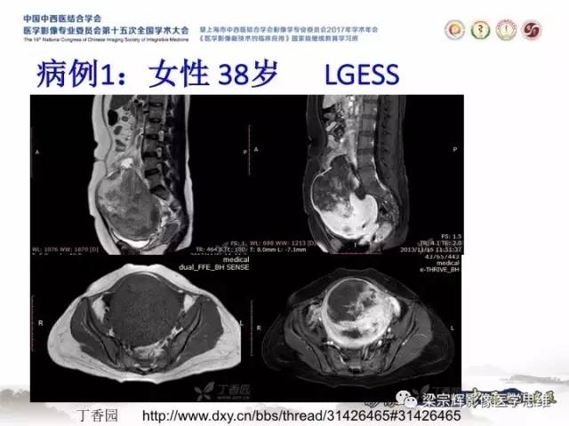 【病例】子宫内膜间质肉瘤1例MR影像表现