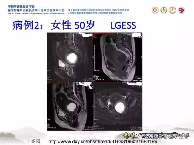 【病例】子宫内膜间质肉瘤1例MR影像表现