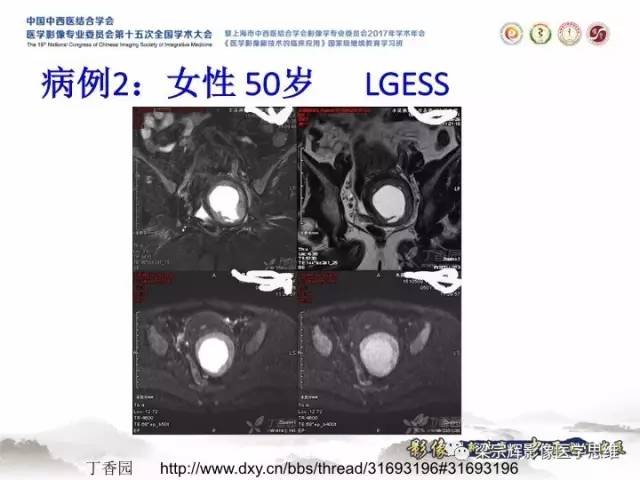 【病例】子宫内膜间质肉瘤1例MR影像表现
