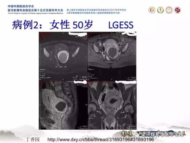 【病例】子宫内膜间质肉瘤1例MR影像表现