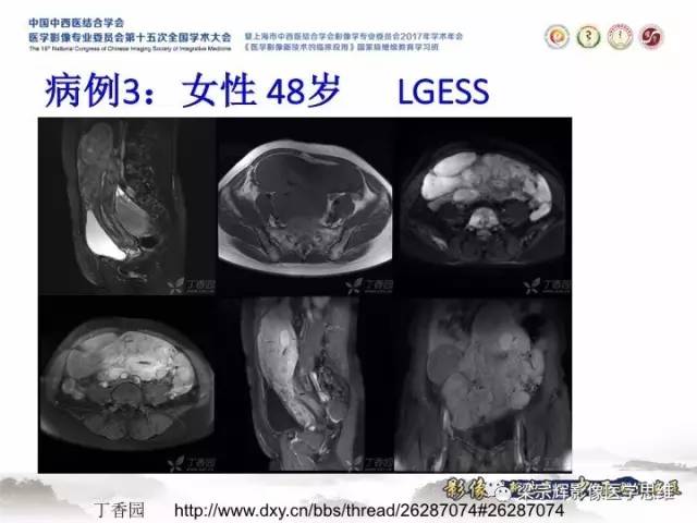 【病例】子宫内膜间质肉瘤1例MR影像表现