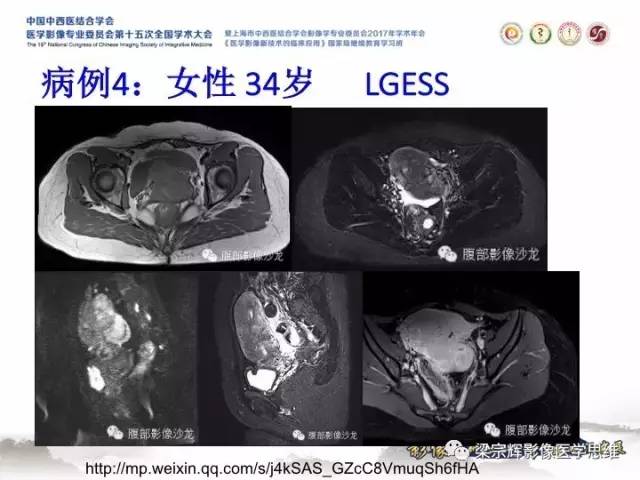 【病例】子宫内膜间质肉瘤1例MR影像表现