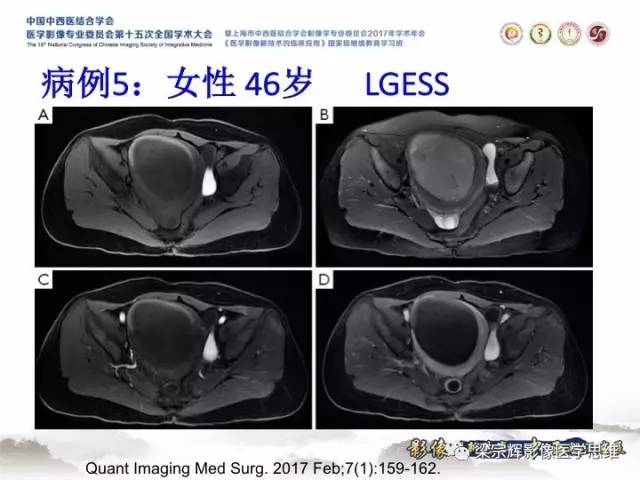 【病例】子宫内膜间质肉瘤1例MR影像表现