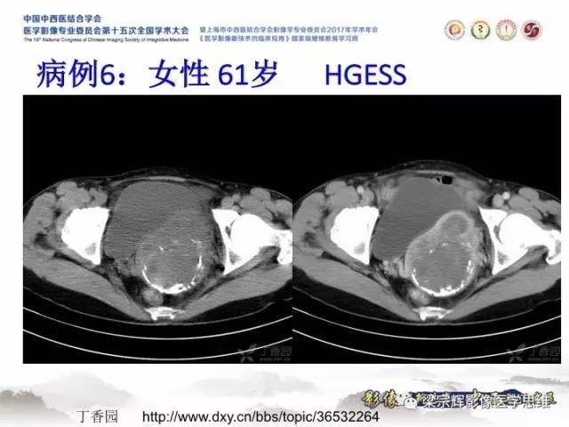 【病例】子宫内膜间质肉瘤1例MR影像表现