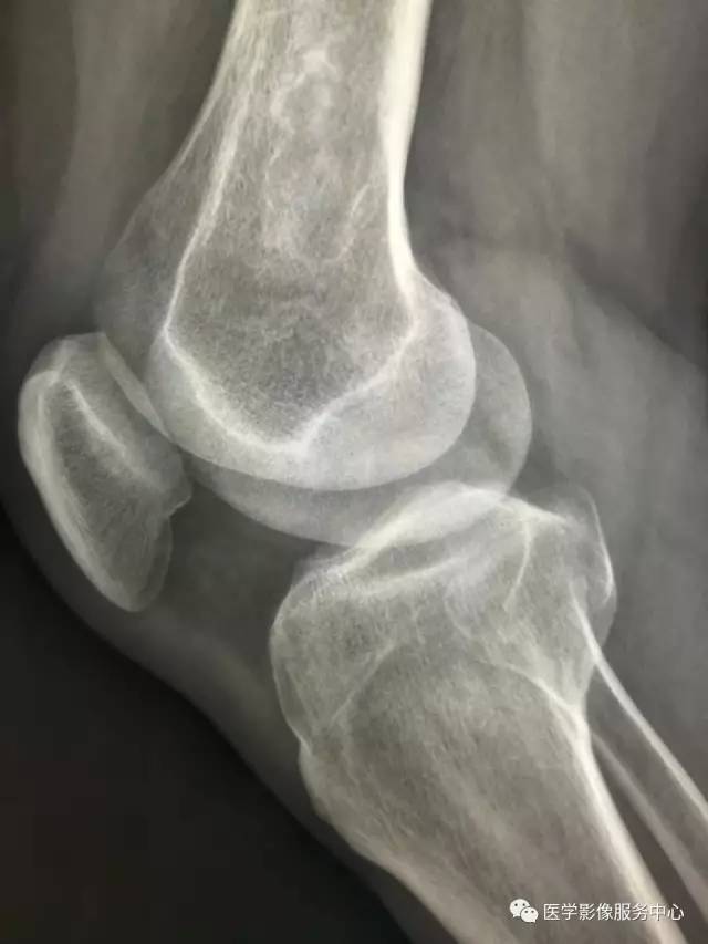 【病例】花环样的骨性病变一定要想到它——双侧股骨远端骨梗死1例 【病例】花环样的骨性病变一定要想到它——双侧股骨远端骨梗死1例