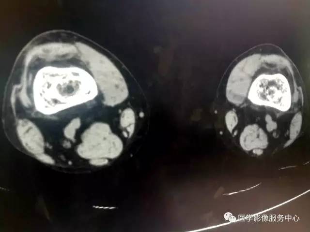 【病例】花环样的骨性病变一定要想到它——双侧股骨远端骨梗死1例 【病例】花环样的骨性病变一定要想到它——双侧股骨远端骨梗死1例