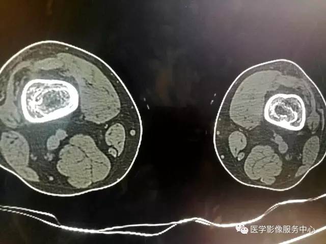 【病例】花环样的骨性病变一定要想到它——双侧股骨远端骨梗死1例 【病例】花环样的骨性病变一定要想到它——双侧股骨远端骨梗死1例