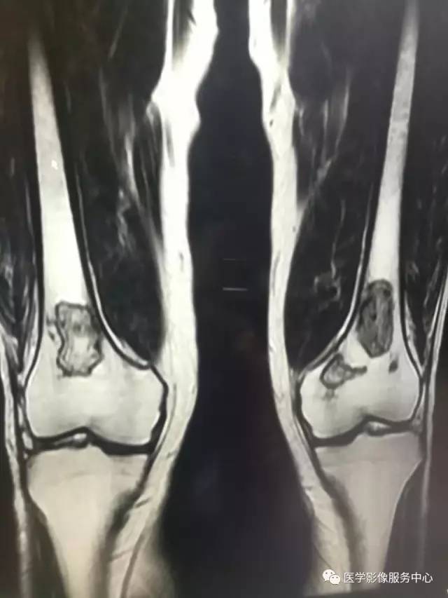 【病例】花环样的骨性病变一定要想到它——双侧股骨远端骨梗死1例 【病例】花环样的骨性病变一定要想到它——双侧股骨远端骨梗死1例