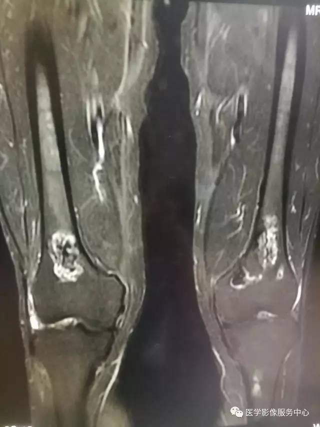 【病例】花环样的骨性病变一定要想到它——双侧股骨远端骨梗死1例 【病例】花环样的骨性病变一定要想到它——双侧股骨远端骨梗死1例