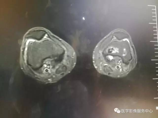 【病例】花环样的骨性病变一定要想到它——双侧股骨远端骨梗死1例 【病例】花环样的骨性病变一定要想到它——双侧股骨远端骨梗死1例