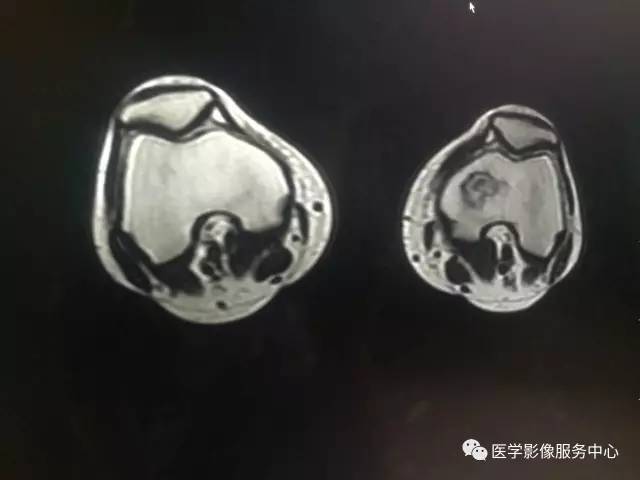 【病例】花环样的骨性病变一定要想到它——双侧股骨远端骨梗死1例 【病例】花环样的骨性病变一定要想到它——双侧股骨远端骨梗死1例