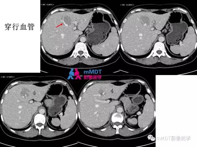 【PPT】肝脏血管穿行征病变影像分析