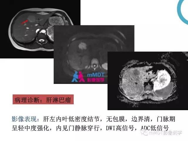 【PPT】肝脏血管穿行征病变影像分析
