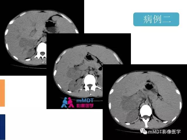 【PPT】肝脏血管穿行征病变影像分析