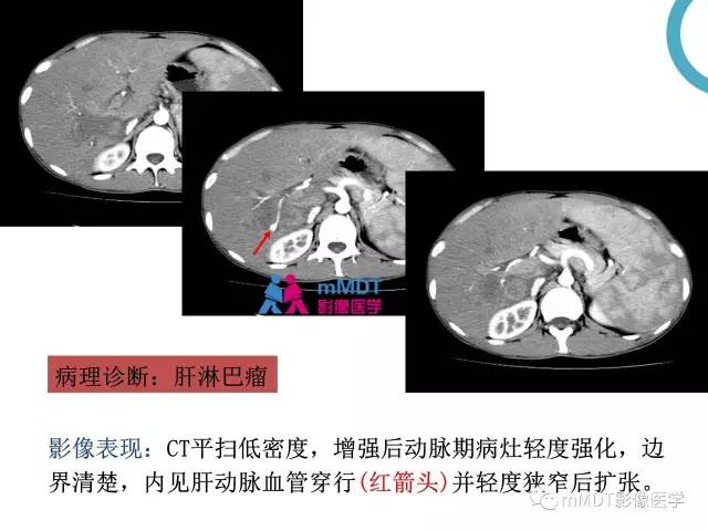 【PPT】肝脏血管穿行征病变影像分析