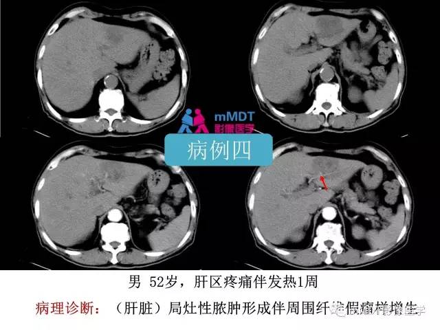 【PPT】肝脏血管穿行征病变影像分析