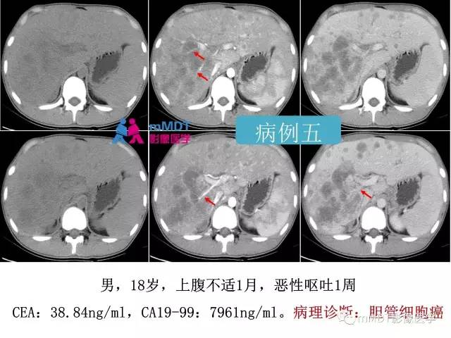 【PPT】肝脏血管穿行征病变影像分析
