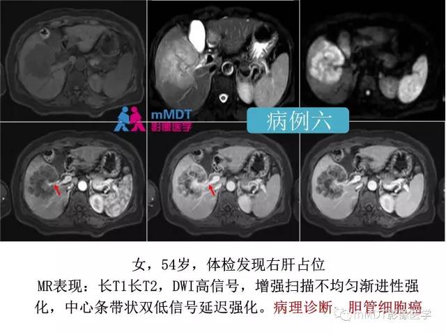 【PPT】肝脏血管穿行征病变影像分析