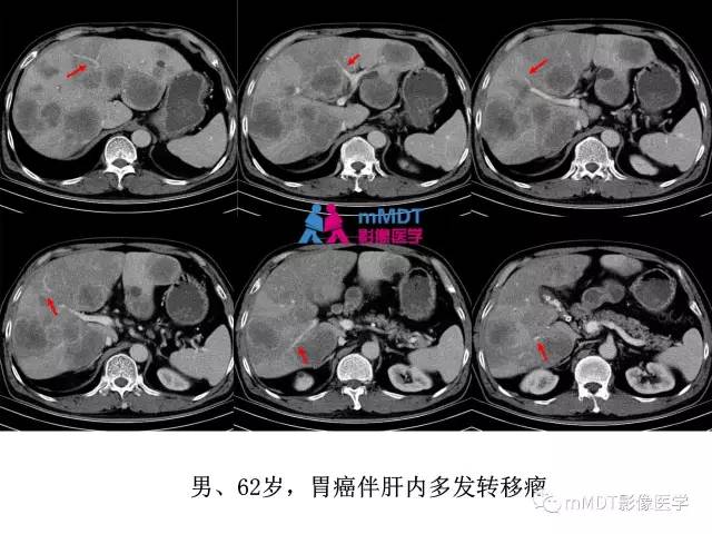 【PPT】肝脏血管穿行征病变影像分析