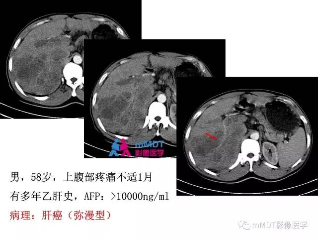 【PPT】肝脏血管穿行征病变影像分析