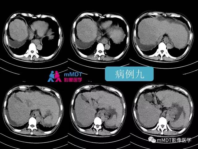 【PPT】肝脏血管穿行征病变影像分析