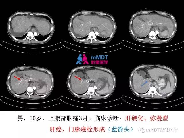 【PPT】肝脏血管穿行征病变影像分析