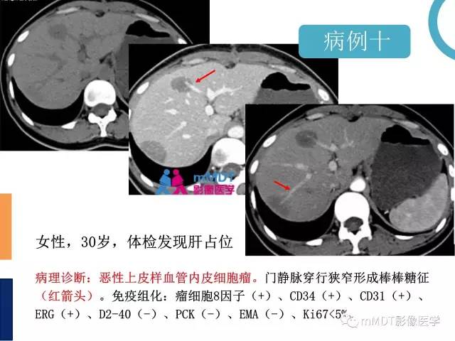 【PPT】肝脏血管穿行征病变影像分析