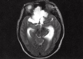 【病例】右额部表皮样囊肿1例MR影像表现 【病例】右额部表皮样囊肿1例MR影像表现