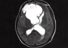 【病例】右额部表皮样囊肿1例MR影像表现 【病例】右额部表皮样囊肿1例MR影像表现