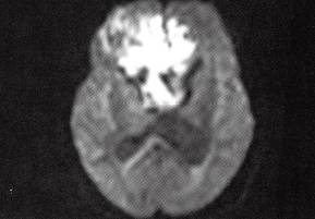 【病例】右额部表皮样囊肿1例MR影像表现 【病例】右额部表皮样囊肿1例MR影像表现