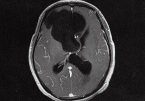 【病例】右额部表皮样囊肿1例MR影像表现 【病例】右额部表皮样囊肿1例MR影像表现