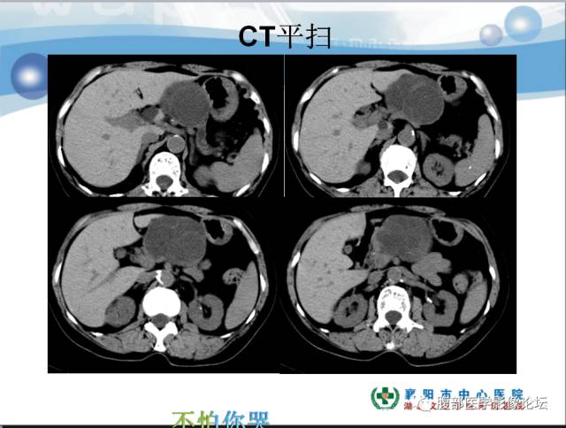 【病例】胰腺淋巴管瘤1例CT影像表现