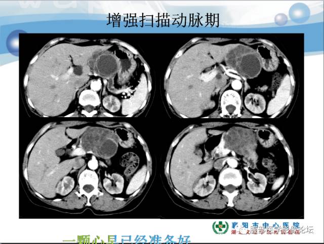 【病例】胰腺淋巴管瘤1例CT影像表现