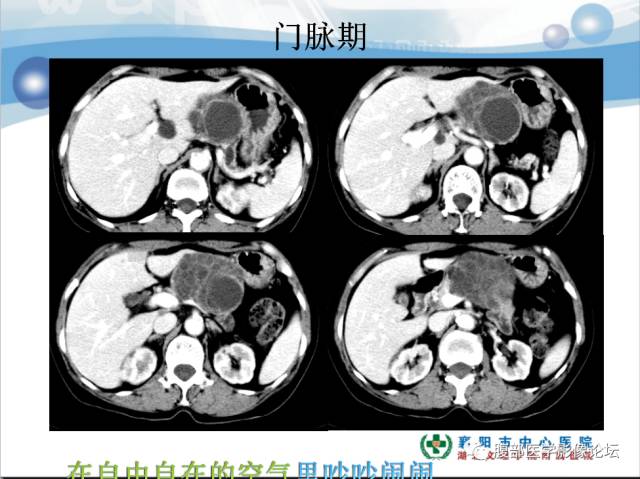 【病例】胰腺淋巴管瘤1例CT影像表现