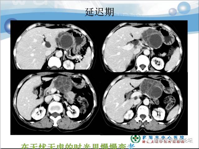【病例】胰腺淋巴管瘤1例CT影像表现