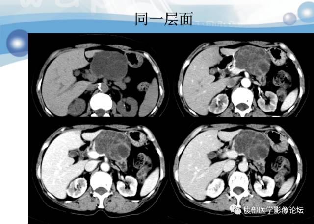 【病例】胰腺淋巴管瘤1例CT影像表现