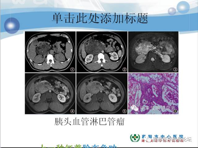 【病例】胰腺淋巴管瘤1例CT影像表现