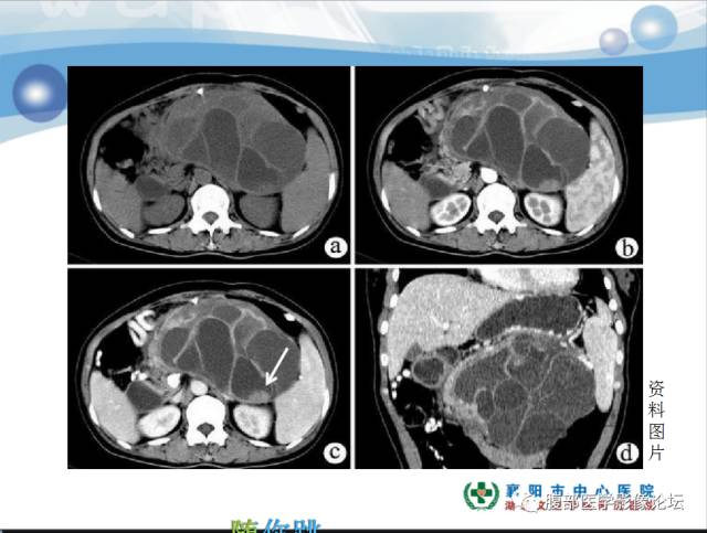 【病例】胰腺淋巴管瘤1例CT影像表现