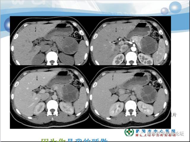 【病例】胰腺淋巴管瘤1例CT影像表现