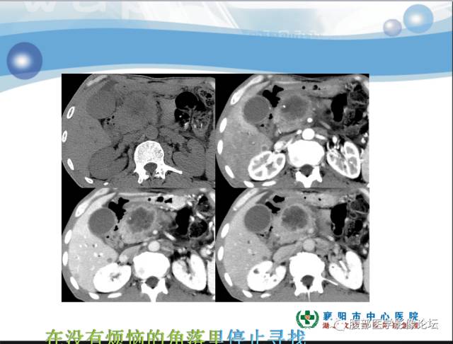 【病例】胰腺淋巴管瘤1例CT影像表现