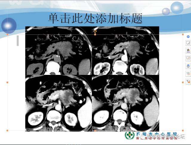 【病例】胰腺淋巴管瘤1例CT影像表现