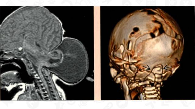 【PPT】One Disease:Chiari 3 【PPT】One Disease:Chiari 3